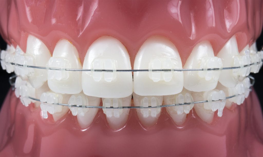 Tratamiento Convencional con Brackets Kreisberg Ortodoncia